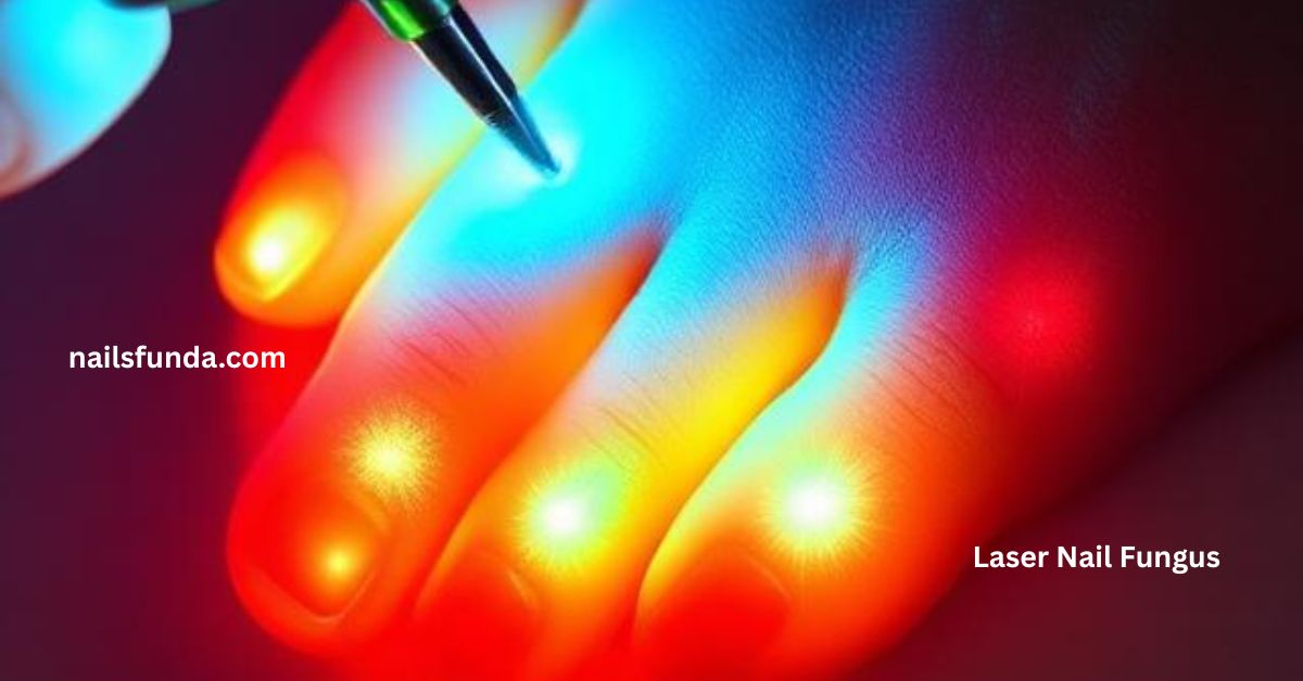 Laser nail fungus